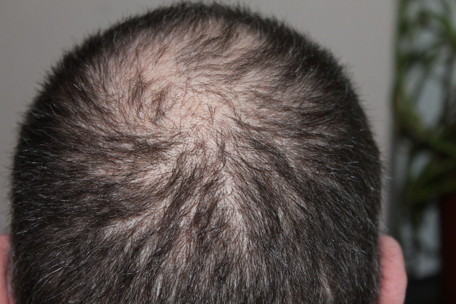 Erblicher Haarausfall entschlüsselt